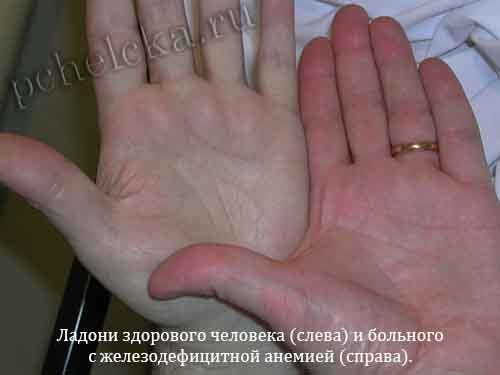 Ладони здорового человека и больного анемией Анемия